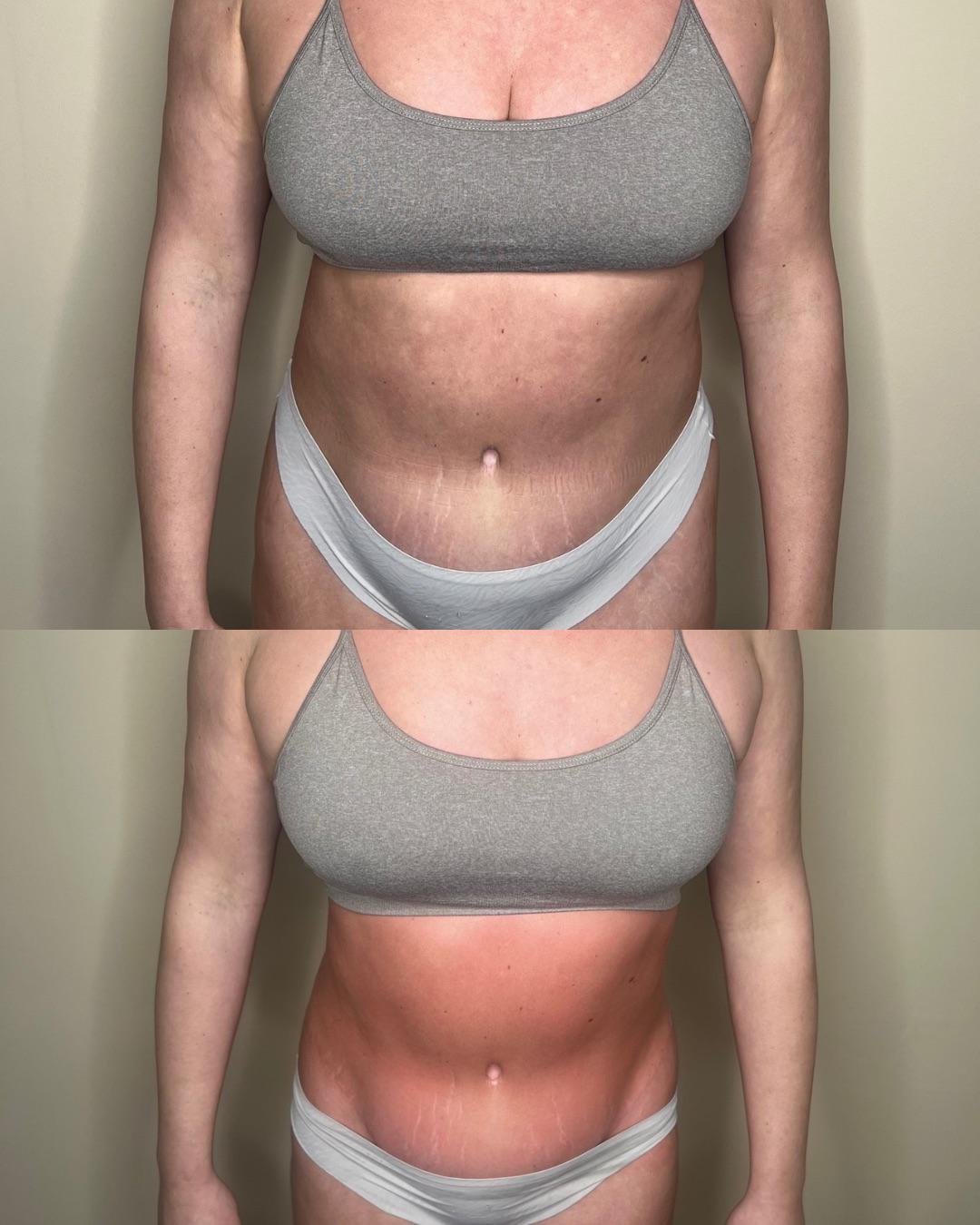 BioSlimming results